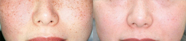 Intense Pulsed Light Before/After