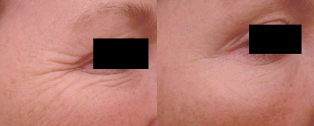 BOTOX Cosmetic Before/after