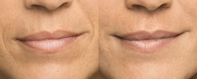 Belotero Before/after