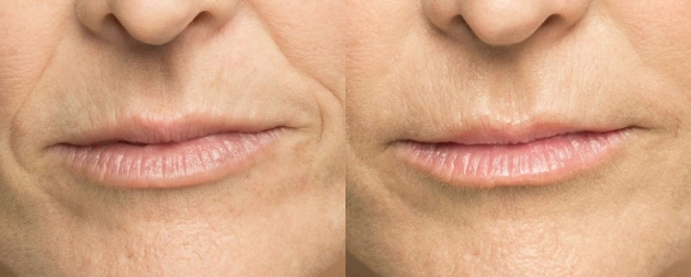 Belotero Before/after