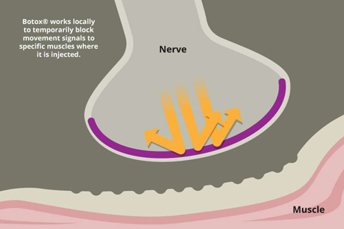 Botox Treatment Areas