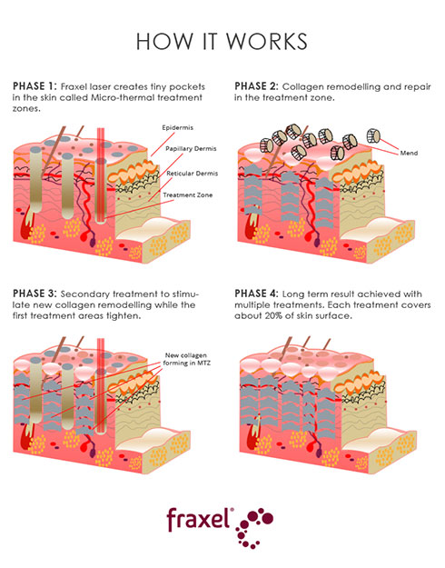 Fraxel Dual Laser works in phases by targeting the surface and inner layers of the skin, encouraging collagen production for skin rejuvenation.
