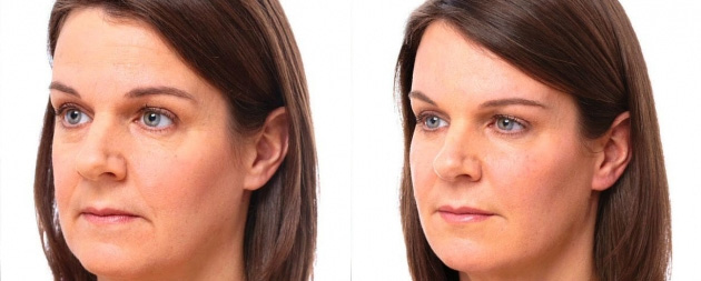 Voluma XC Before/after