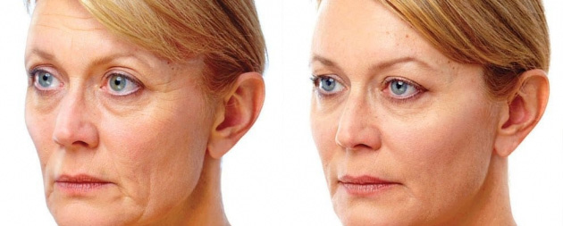 Voluma XC Before/after