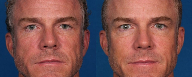 Voluma XC Before/after