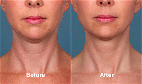 Kybella before after patient