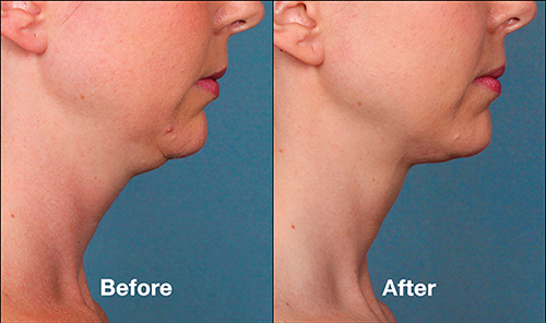 Kybella before after patient