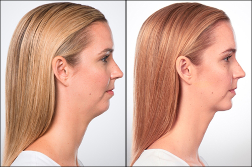 Kybella before after patient