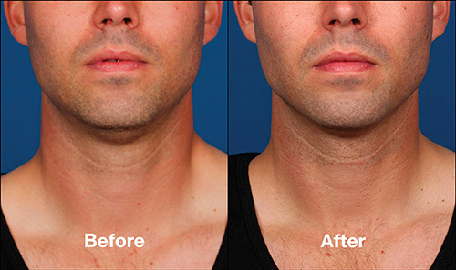 Kybella before after patient