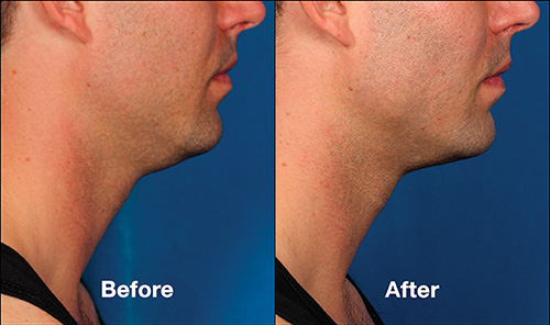 Kybella before after patient