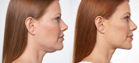 Kybella