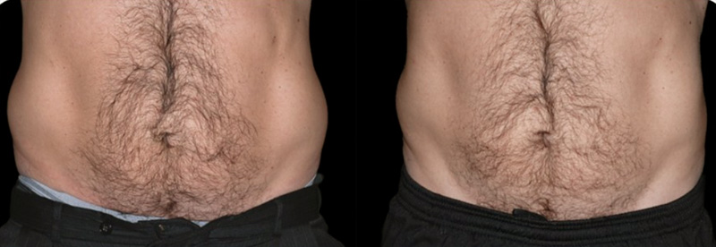 Coolsculpting By Zeltiq