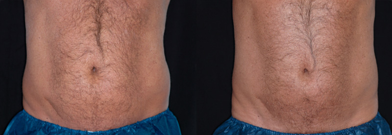 Coolsculpting By Zeltiq