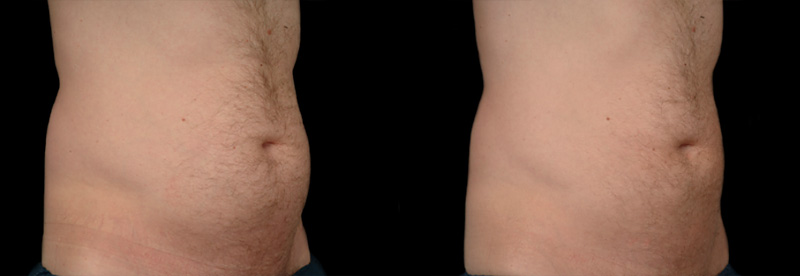 Coolsculpting By Zeltiq