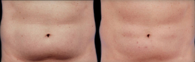 Get Rid of Bra Fat Flanks With Coolsculpting Beverly Hills