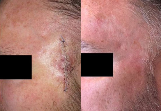 Mohs Scar Before/After