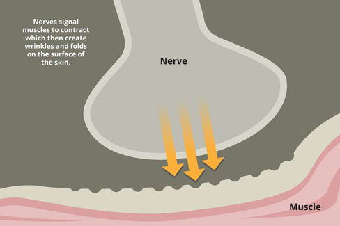 Botox Treatment Areas