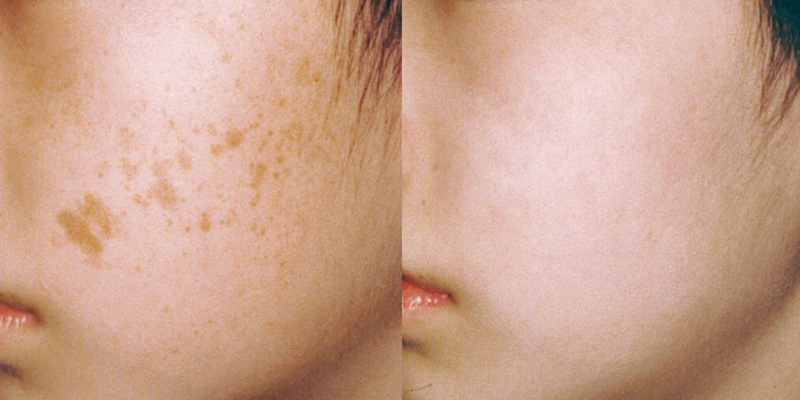 Resurface-Lasers IPL Before/After