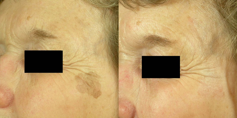Resurface-Lasers IPL Before/After
