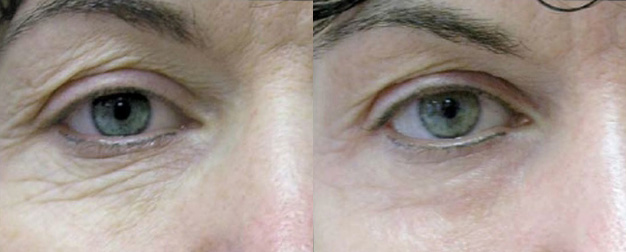 UltraPulse Before/After