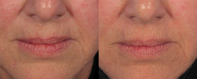 UltraPulse Before/After
