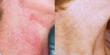 VBEAM & Excel V Before/After