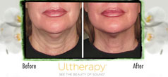Reduce With Kybella and Refine With Ultherapy