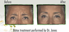 Relax With Botox