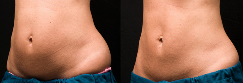 Coolsculpting By Zeltiq