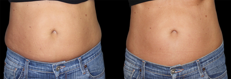Coolsculpting By Zeltiq
